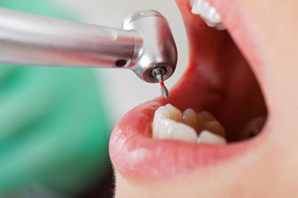 Best Emergency Root Canal Treatment in Crossville, AL